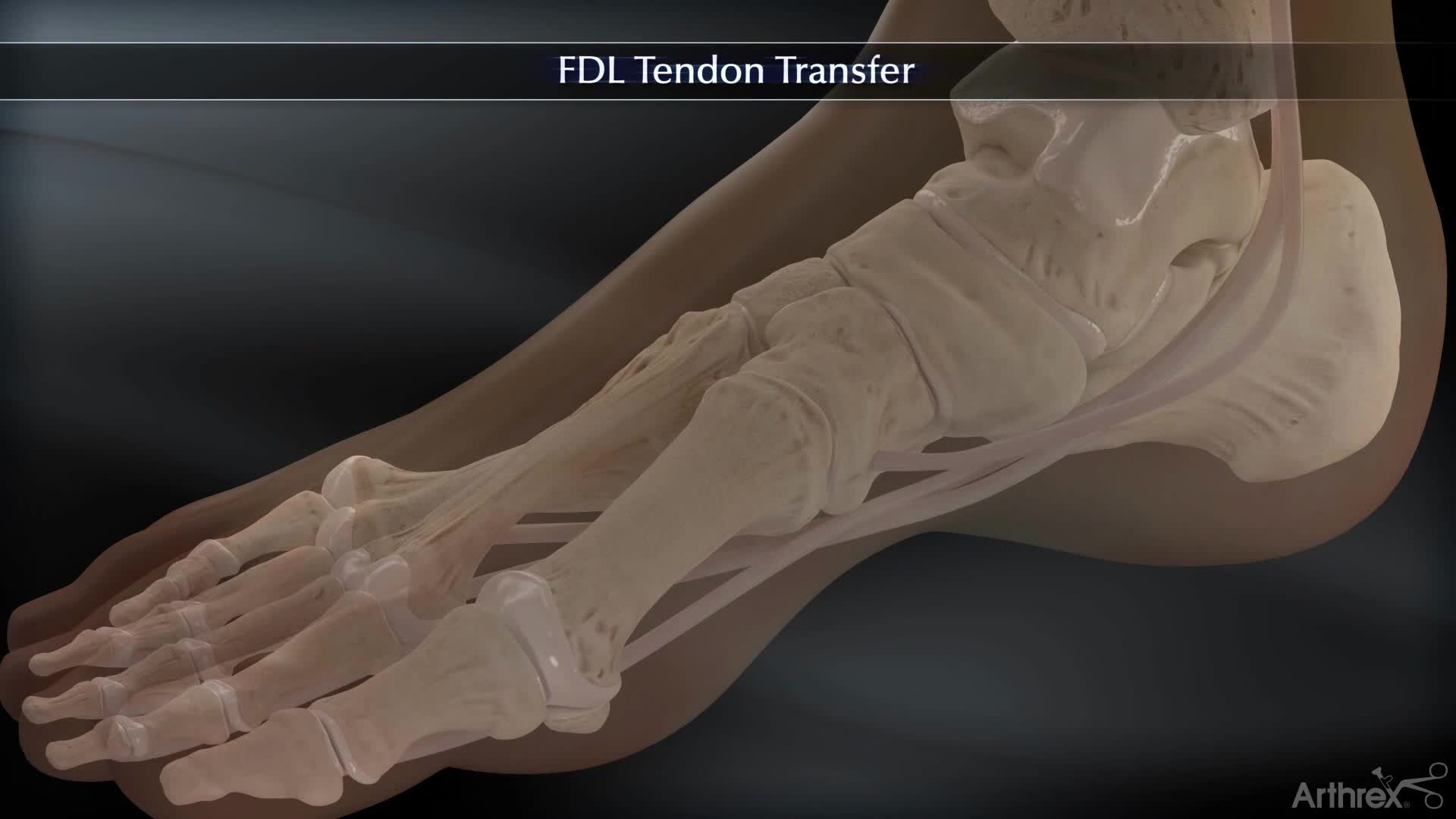 Flexor Digitorum Longus Tendon Transfer for Arch Support